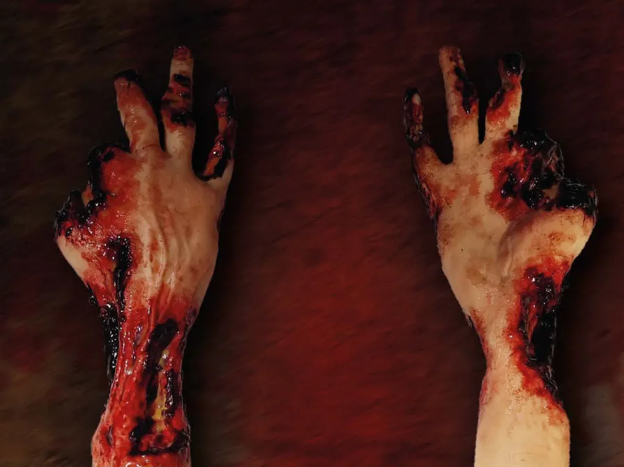 Trauma Arm
